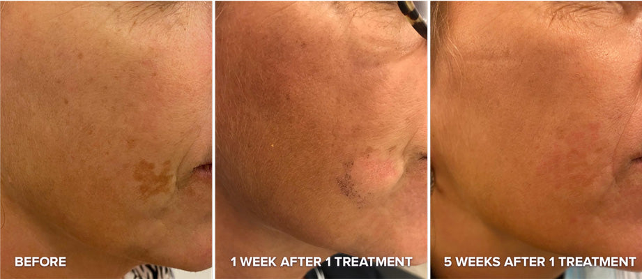 PHOTO REJUVENATION FACIAL (IPL)