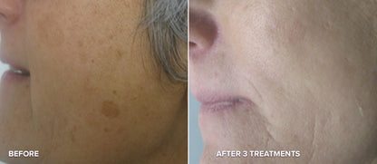 PHOTO REJUVENATION FACIAL (IPL)