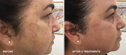 PHOTO REJUVENATION FACIAL (IPL)