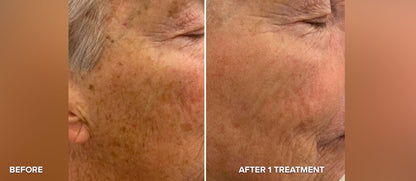 PHOTO REJUVENATION FACIAL (IPL)