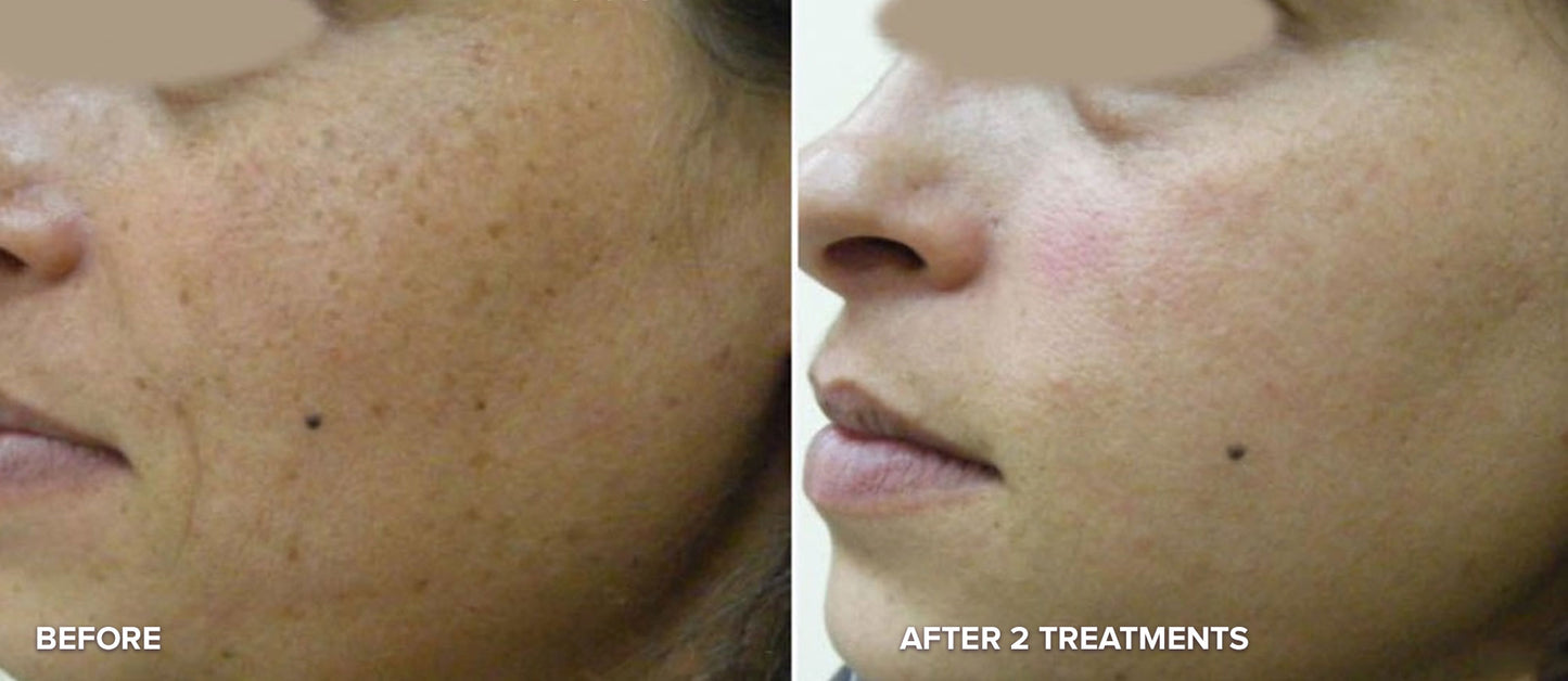 PHOTO REJUVENATION FACIAL (IPL)