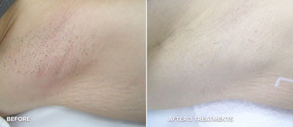 LASER HAIR REMOVAL