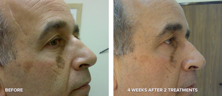 PHOTO REJUVENATION FACIAL (IPL)