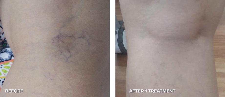 Varicose Veins Treatment