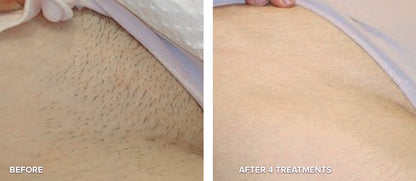 LASER HAIR REMOVAL