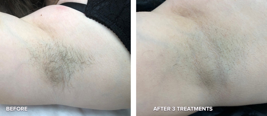 LASER HAIR REMOVAL